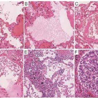 histological picture   lungs  signs   exudative phase