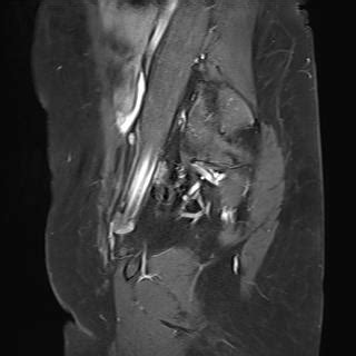 Uterine Intramural Submucosal Leiomyoma Image Radiopaedia Org