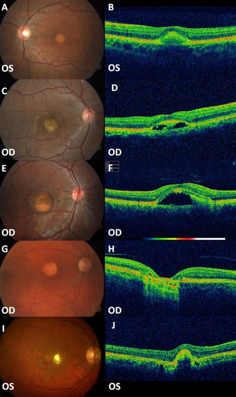 Different Stages Of Vmd Fundus Photographs And Oct A B Vitellifom