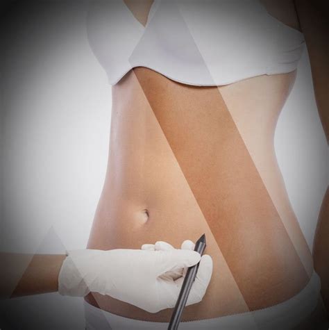 Mini Tummy Tuck Turkey Low Price Mini Abdominoplasty