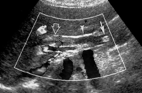 Oblique Us Image Of The Porta Hepatis Obtained In A Slightly Different Download Scientific