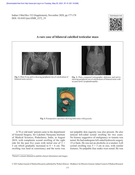 Pdf A Rare Case Of Bilateral Calcified Testicular Mass