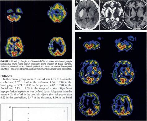 Diaschisis In Patient With Basal Ganglia Hematoma A Initialct Shows