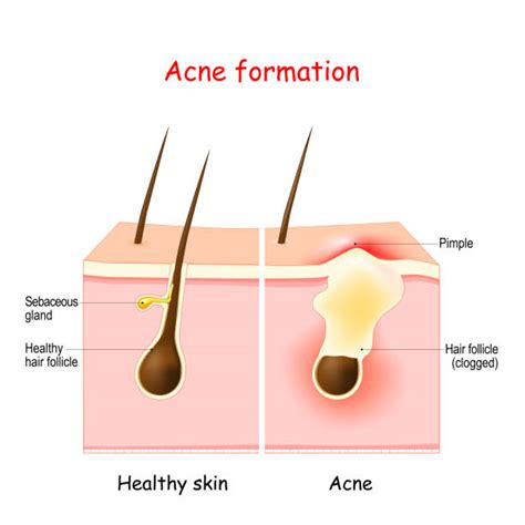 200+ Stages Of A Pimple Stock Illustrations, Royalty-Free Vector ...