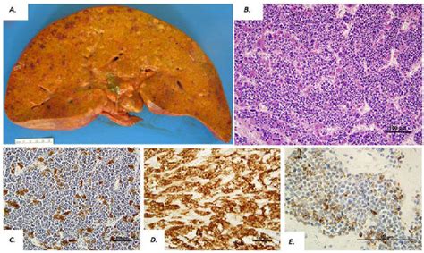 Figure 1 From Unique Morphologic And Clinical Features Of Liver Predominantprimary Small Cell