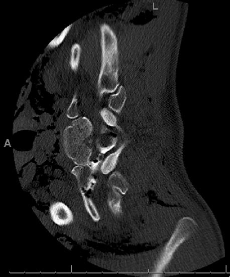 Axial Ct Myelogram At The Level Of The T1 T2 Neural Foramen With The Download Scientific