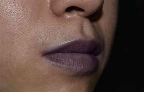 What Causes Cyanosis Lips