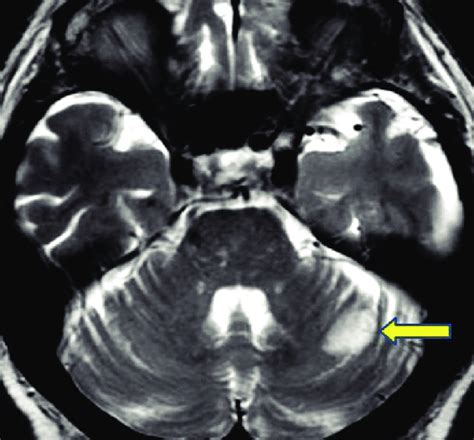 T2 Weighted Magnetic Resonance Imaging Showing Infarction Yellow Arrow Download Scientific