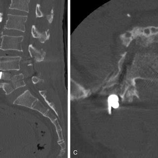 Perioperative Imaging For The First Operation A Lateral Radiographs