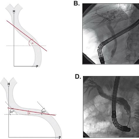 Angle α Correlates With The Common Bile Duct Diameter The Angle α And