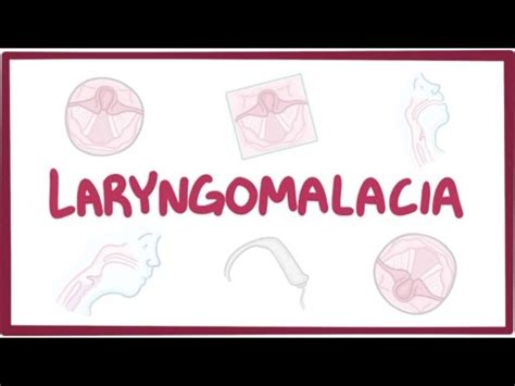 Laryngomalacia - causes, symptoms, diagnosis, treatment, pathology