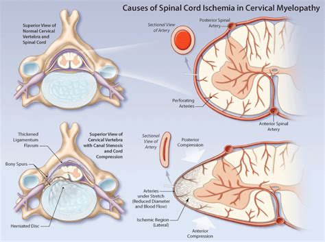 Cervical myelopathy | HealthPlexus.net