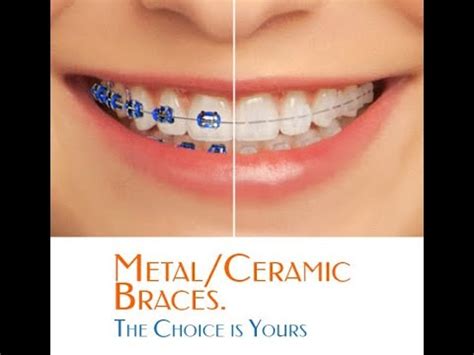 Metal Vs Ceramic Braces Procedure Comparison Youtube