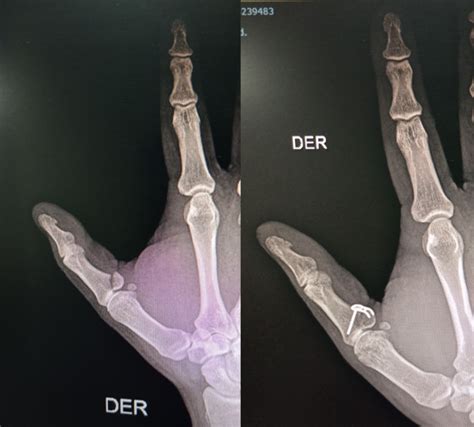 Fractura De Dedos Y De Metacarpianos