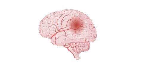 Brain Damage: Definition, Types, and Causes I NotesBard