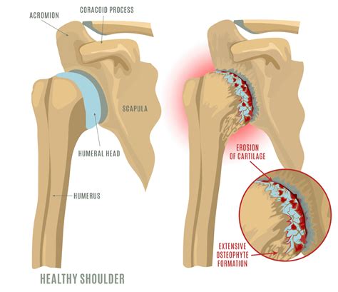 Total Shoulder Replacement What To Expect Kyle McClintock DO