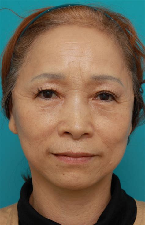 【症例写真】60代女性に行ったミニフェイスリフト（頬のたるみ取り）症例：美容外科 高須クリニック