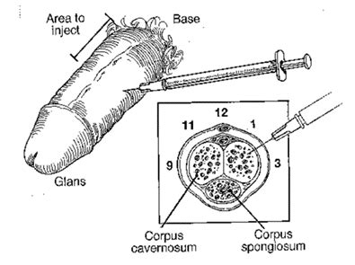 Trimix Injections For Men Bioenve