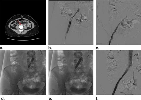 A Ct Showed May Thurner Syndrome B Venography Showed That Significant