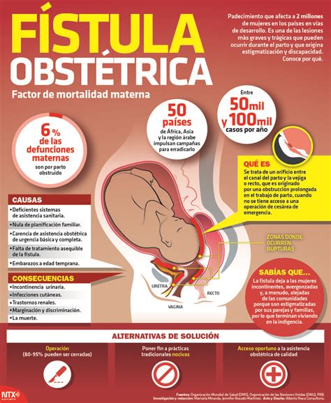 La Fistula Obstétrica Es Una Lesión Que Puede Ocurrir Durante El Parto