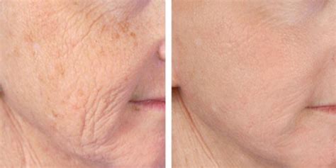 How Long After Botox Can You Get Microneedling The Beautious