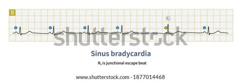 13 Bradycardia Causes Images, Stock Photos & Vectors | Shutterstock