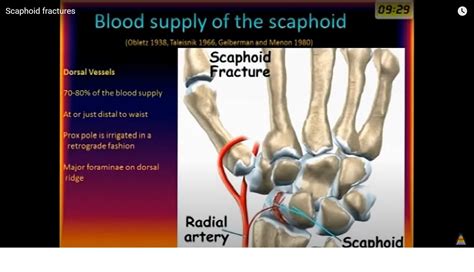 Scaphoid Fracture Types