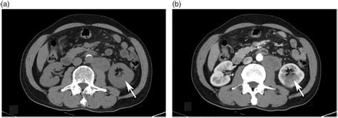 Contrast Enhanced Abdominal Computed Tomography Showing An Isodensity