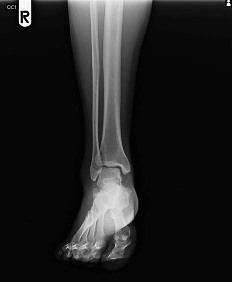 Ankle Fracture X Ray Film Images Stock Photos D Objects