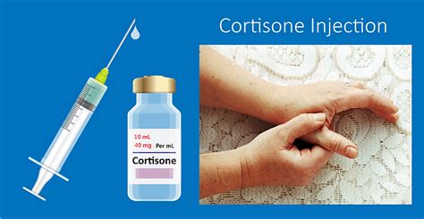 Effective Steroid And Cortisone Injections For Wrist Pain In Kingston