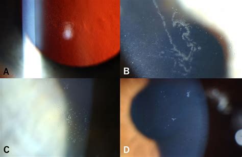 Corneal Microcysts British Journal Of Ophthalmology