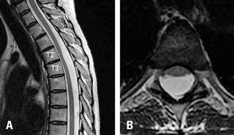 Spinal Arachnoid Cyst