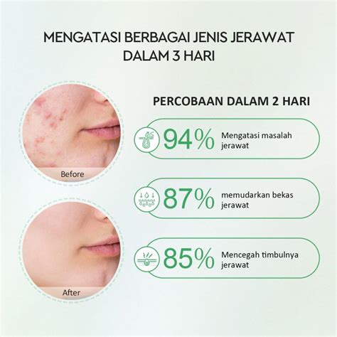 Jual Glad Glow Centella Salicylic Acid Power Acne Serum Termurah