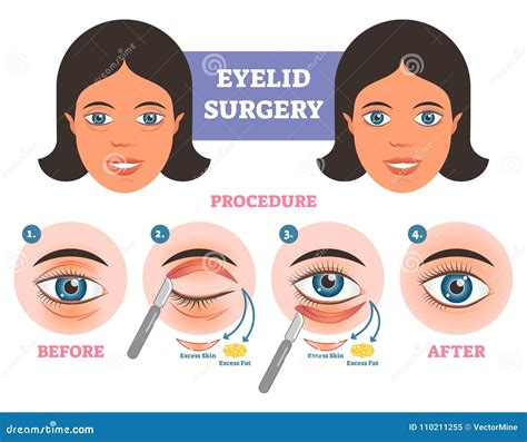 Eyelid Surgery Procedure before after Illuatration with Main Steps ...