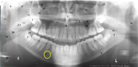 Panoramic Radiograph Flashcards Quizlet