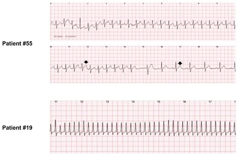 Paroxysmal Supraventricular Tachycardia And Atrial Tachycardia Detected Download Scientific