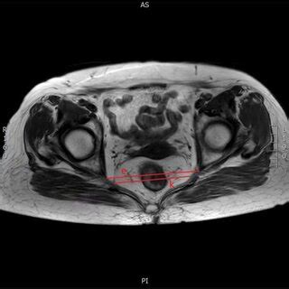 Sagittal Magnetic Resonance Image Of The Pelvis L T Angle I E The