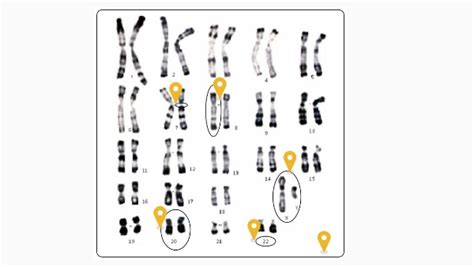 Analyse Caryotype Normal