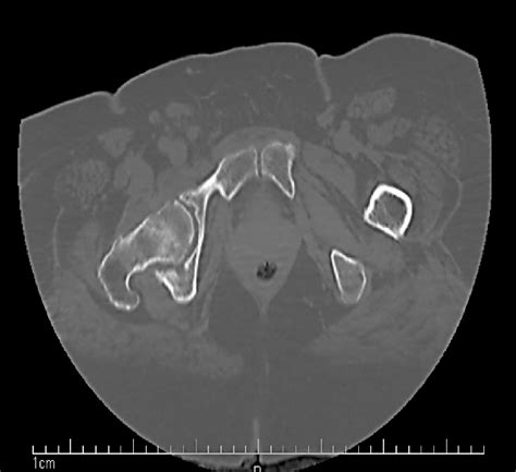 A Axial Ct Scan Of The Pelvis Without Contrast Advanced Degenerative Download Scientific