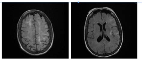 Manejo De Un Evento Adverso Embolia Gaseosa Cerebral Asociada A