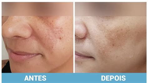 Valores Tratamento De Melasma Clínica De Pele Dr Szerman 2024