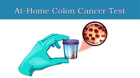 Colon Cancer Stool Chart