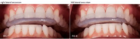 Modifying An Anterior Bite Plane With Durasplint Lc Spear Education