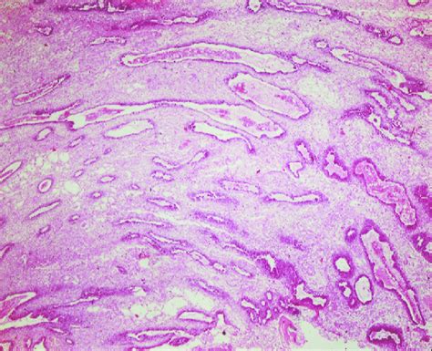 Photomicrograph Showing Proliferation Of Odontogenic Epithelium In