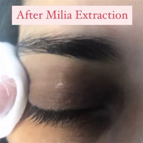 What Is Milia? Causes, Types, Precautions And Remedies