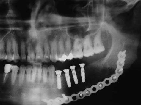 Patient 7: x-ray of bone graft and 4 dental implants (the image does... | Download Scientific ...