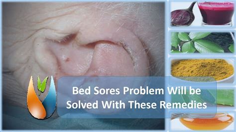 Bed Sores Problem Will Be Solved With These Remedies Youtube