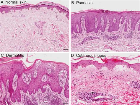 Psoriasis Skin Diagram