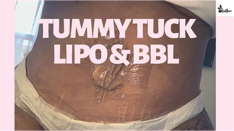 Tummy tuck, lipo & BBL: At home CARE & RECOVERY after TT and Brazilian ...