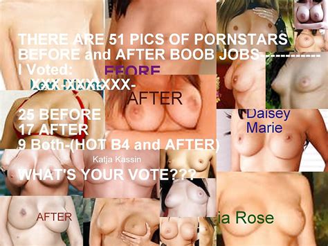 B And After Boob Job Vote Porn Pictures XXX Photos Sex Images PICTOA